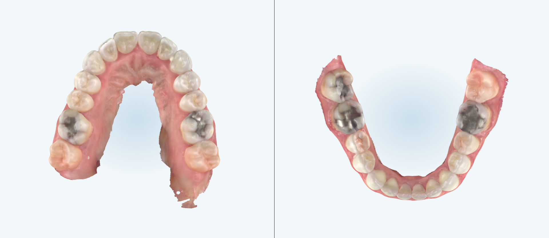 Dental expansion treatment comparison case 1 after